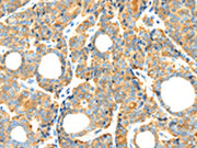 The image on the left is immunohistochemistry of paraffin-embedded Human thyroid cancer tissue using CSB-PA436282(RIPK4 Antibody) at dilution 1/40, on the right is treated with synthetic peptide. (Original magnification: ×200)