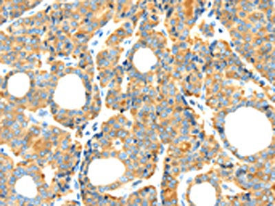 The image on the left is immunohistochemistry of paraffin-embedded Human thyroid cancer tissue using CSB-PA436282(RIPK4 Antibody) at dilution 1/40, on the right is treated with synthetic peptide. (Original magnification: ×200)