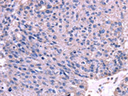 The image on the left is immunohistochemistry of paraffin-embedded Human breast cancer tissue using CSB-PA436398(TRIM14 Antibody) at dilution 1/35, on the right is treated with fusion protein. (Original magnification: ×200)