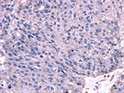 The image on the left is immunohistochemistry of paraffin-embedded Human breast cancer tissue using CSB-PA436398(TRIM14 Antibody) at dilution 1/35, on the right is treated with fusion protein. (Original magnification: ×200)