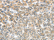 The image on the left is immunohistochemistry of paraffin-embedded Human liver cancer tissue using CSB-PA436403(TRIM16 Antibody) at dilution 1/35, on the right is treated with fusion protein. (Original magnification: ×200)