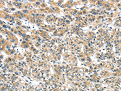 The image on the left is immunohistochemistry of paraffin-embedded Human liver cancer tissue using CSB-PA436403(TRIM16 Antibody) at dilution 1/35, on the right is treated with fusion protein. (Original magnification: ×200)