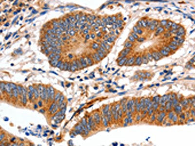 The image on the left is immunohistochemistry of paraffin-embedded Human colon cancer tissue using CSB-PA436421(MYH7 Antibody) at dilution 1/12, on the right is treated with fusion protein. (Original magnification: ×200)