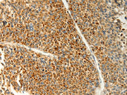 The image on the left is immunohistochemistry of paraffin-embedded Human liver cancer tissue using CSB-PA436548(TRAF1 Antibody) at dilution 1/20, on the right is treated with fusion protein. (Original magnification: ×200)