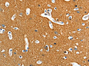 The image on the left is immunohistochemistry of paraffin-embedded Human brain tissue using CSB-PA436650(ADD2 Antibody) at dilution 1/15, on the right is treated with fusion protein. (Original magnification: ×200)