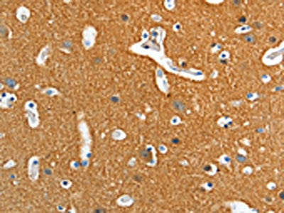 The image on the left is immunohistochemistry of paraffin-embedded Human brain tissue using CSB-PA436650(ADD2 Antibody) at dilution 1/15, on the right is treated with fusion protein. (Original magnification: ×200)