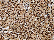The image on the left is immunohistochemistry of paraffin-embedded Human breast cancer tissue using CSB-PA436777(SSB Antibody) at dilution 1/25, on the right is treated with synthetic peptide. (Original magnification: ×200)