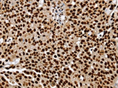 The image on the left is immunohistochemistry of paraffin-embedded Human breast cancer tissue using CSB-PA436777(SSB Antibody) at dilution 1/25, on the right is treated with synthetic peptide. (Original magnification: ×200)