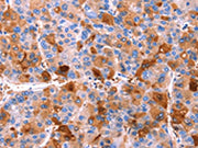 The image on the left is immunohistochemistry of paraffin-embedded Human liver cancer tissue using CSB-PA436972(ERN2 Antibody) at dilution 1/40, on the right is treated with synthetic peptide. (Original magnification: ×200)