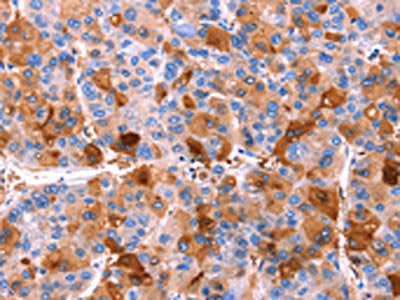 The image on the left is immunohistochemistry of paraffin-embedded Human liver cancer tissue using CSB-PA436972(ERN2 Antibody) at dilution 1/40, on the right is treated with synthetic peptide. (Original magnification: ×200)