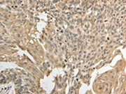 The image on the left is immunohistochemistry of paraffin-embedded Human cervical cancer tissue using CSB-PA436998(GSR Antibody) at dilution 1/50, on the right is treated with fusion protein. (Original magnification: ×200)