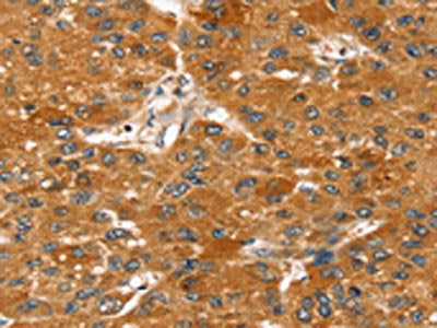 The image on the left is immunohistochemistry of paraffin-embedded Human liver cancer tissue using CSB-PA437034(STARD8 Antibody) at dilution 1/20, on the right is treated with fusion protein. (Original magnification: ×200)