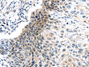 The image on the left is immunohistochemistry of paraffin-embedded Human esophagus cancer tissue using CSB-PA437170(CENPM Antibody) at dilution 1/20, on the right is treated with fusion protein. (Original magnification: ×200)