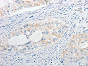 The image on the left is immunohistochemistry of paraffin-embedded Human cervical cancer tissue using CSB-PA437340(MPZ Antibody) at dilution 1/15, on the right is treated with fusion protein. (Original magnification: ×200)