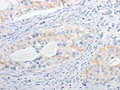 The image on the left is immunohistochemistry of paraffin-embedded Human cervical cancer tissue using CSB-PA437340(MPZ Antibody) at dilution 1/15, on the right is treated with fusion protein. (Original magnification: ×200)