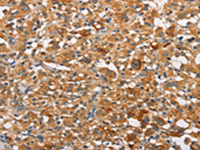The image on the left is immunohistochemistry of paraffin-embedded Human thyroid cancer tissue using CSB-PA437351(PRKCE Antibody) at dilution 1/30, on the right is treated with fusion protein. (Original magnification: ×200)
