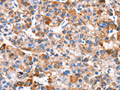 The image on the left is immunohistochemistry of paraffin-embedded Human liver cancer tissue using CSB-PA437479(EPO Antibody) at dilution 1/15, on the right is treated with synthetic peptide. (Original magnification: ×200)
