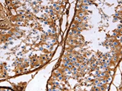 The image on the left is immunohistochemistry of paraffin-embedded Human testis tissue using CSB-PA437587(CALD1 Antibody) at dilution 1/40, on the right is treated with fusion protein. (Original magnification: ×200)
