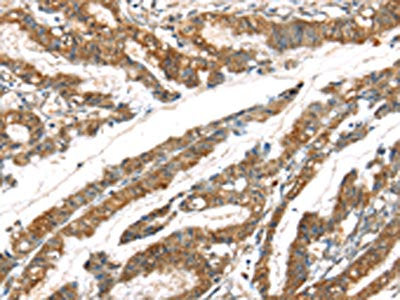 The image on the left is immunohistochemistry of paraffin-embedded Human esophagus cancer tissue using CSB-PA437630(GPD2 Antibody) at dilution 1/20, on the right is treated with synthetic peptide. (Original magnification: ×200)