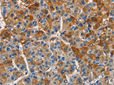The image on the left is immunohistochemistry of paraffin-embedded Human liver cancer tissue using CSB-PA437759(CST4 Antibody) at dilution 1/60, on the right is treated with fusion protein. (Original magnification: ×200)