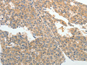 The image on the left is immunohistochemistry of paraffin-embedded Human liver cancer tissue using CSB-PA437890(ABCB11 Antibody) at dilution 1/25, on the right is treated with synthetic peptide. (Original magnification: ×200)