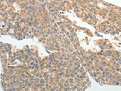 The image on the left is immunohistochemistry of paraffin-embedded Human liver cancer tissue using CSB-PA437890(ABCB11 Antibody) at dilution 1/25, on the right is treated with synthetic peptide. (Original magnification: ×200)