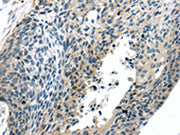 The image on the left is immunohistochemistry of paraffin-embedded Human esophagus cancer tissue using CSB-PA437965(BOK(BH3 domain) Antibody) at dilution 1/20, on the right is treated with synthetic peptide.