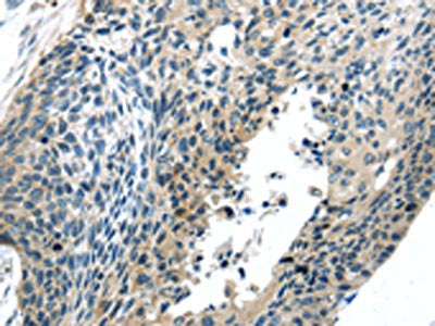 The image on the left is immunohistochemistry of paraffin-embedded Human esophagus cancer tissue using CSB-PA437965(BOK(BH3 domain) Antibody) at dilution 1/20, on the right is treated with synthetic peptide.