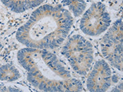 The image on the left is immunohistochemistry of paraffin-embedded Human colon cancer tissue using CSB-PA437981(COL2A1 Antibody) at dilution 1/15, on the right is treated with fusion protein. (Original magnification: X200)