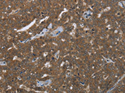 The image on the left is immunohistochemistry of paraffin-embedded Human ovarian cancer tissue using CSB-PA437995(FASTKD1 Antibody) at dilution 1/50, on the right is treated with fusion protein. (Original magnification: ×200)