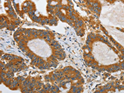 The image on the left is immunohistochemistry of paraffin-embedded Human colon cancer tissue using CSB-PA438009(ATG4A Antibody) at dilution 1/45, on the right is treated with synthetic peptide. (Original magnification: ×200)