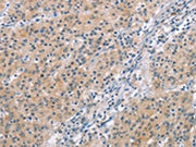 The image on the left is immunohistochemistry of paraffin-embedded Human gastic cancer tissue using CSB-PA438059(MCL1 Antibody) at dilution 1/60, on the right is treated with synthetic peptide. (Original magnification: ×200)
