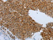 The image on the left is immunohistochemistry of paraffin-embedded Human liver cancer tissue using CSB-PA438177(PTPRJ Antibody) at dilution 1/40, on the right is treated with synthetic peptide. (Original magnification: ×200)