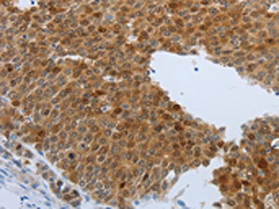 The image on the left is immunohistochemistry of paraffin-embedded Human liver cancer tissue using CSB-PA438177(PTPRJ Antibody) at dilution 1/40, on the right is treated with synthetic peptide. (Original magnification: ×200)