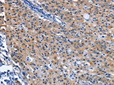 The image on the left is immunohistochemistry of paraffin-embedded Human gastic cancer tissue using CSB-PA438445(CDO1 Antibody) at dilution 1/40, on the right is treated with fusion protein. (Original magnification: ×200)