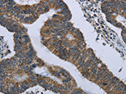 The image on the left is immunohistochemistry of paraffin-embedded Human colon cancer tissue using CSB-PA438683(GYPC Antibody) at dilution 1/60, on the right is treated with fusion protein. (Original magnification: ×200)