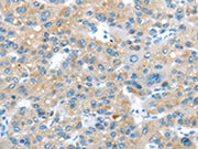 The image on the left is immunohistochemistry of paraffin-embedded Human liver cancer tissue using CSB-PA438768(ERP44 Antibody) at dilution 1/20, on the right is treated with synthetic peptide. (Original magnification: ×200)