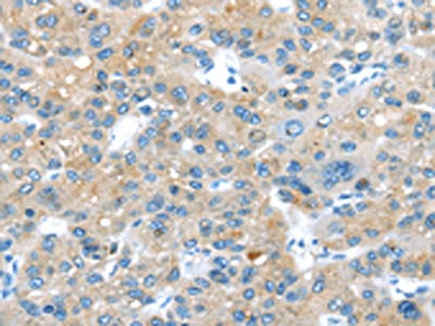 The image on the left is immunohistochemistry of paraffin-embedded Human liver cancer tissue using CSB-PA438768(ERP44 Antibody) at dilution 1/20, on the right is treated with synthetic peptide. (Original magnification: ×200)