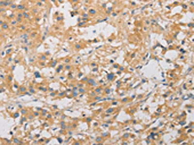 The image on the left is immunohistochemistry of paraffin-embedded Human thyroid cancer tissue using CSB-PA438801(ARSG Antibody) at dilution 1/30, on the right is treated with fusion protein. (Original magnification: ×200)