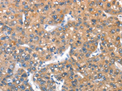 The image on the left is immunohistochemistry of paraffin-embedded Human liver cancer tissue using CSB-PA438854(KEL Antibody) at dilution 1/40, on the right is treated with fusion protein. (Original magnification: ×200)