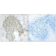 Immunohistochemistry analysis of paraffin-embedded human breast carcinoma tissue using PPP1R2 (Ab-120/121) antibody.