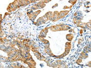 The image on the left is immunohistochemistry of paraffin-embedded Human esophagus cancer tissue using CSB-PA438958(PAK3 Antibody) at dilution 1/25, on the right is treated with synthetic peptide. (Original magnification: ×200)