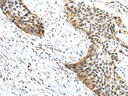 The image on the left is immunohistochemistry of paraffin-embedded Human esophagus cancer tissue using CSB-PA439253(TRIP6 Antibody) at dilution 1/50, on the right is treated with fusion protein. (Original magnification: ×200)