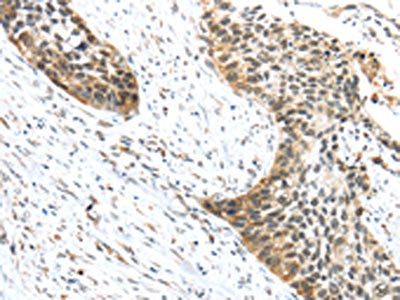 The image on the left is immunohistochemistry of paraffin-embedded Human esophagus cancer tissue using CSB-PA439253(TRIP6 Antibody) at dilution 1/50, on the right is treated with fusion protein. (Original magnification: ×200)