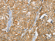 The image on the left is immunohistochemistry of paraffin-embedded Human breast cancer tissue using CSB-PA439524(SLC9A3R2 Antibody) at dilution 1/30, on the right is treated with synthetic peptide. (Original magnification: ×200)