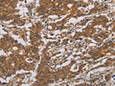 The image is immunohistochemistry of paraffin-embedded Human gastic cancer tissue using CSB-PA439589(CNDP1 Antibody) at dilution 1/30. (Original magnification: ×200)