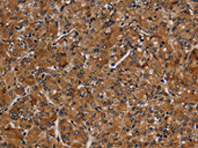 The image on the left is immunohistochemistry of paraffin-embedded Human prostate cancer tissue using CSB-PA439630(CYP1A2 Antibody) at dilution 1/40, on the right is treated with synthetic peptide. (Original magnification: ×200)