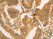 The image on the left is immunohistochemistry of paraffin-embedded Human colon cancer tissue using CSB-PA439706(RPL26L1 Antibody) at dilution 1/30, on the right is treated with fusion protein. (Original magnification: ×200)