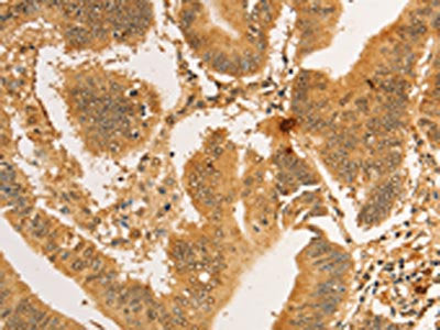The image on the left is immunohistochemistry of paraffin-embedded Human colon cancer tissue using CSB-PA439706(RPL26L1 Antibody) at dilution 1/30, on the right is treated with fusion protein. (Original magnification: ×200)