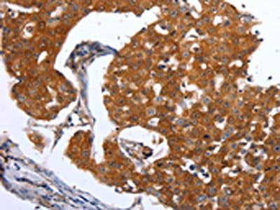 The image on the left is immunohistochemistry of paraffin-embedded Human breast cancer tissue using CSB-PA439945(MAP2K1 Antibody) at dilution 1/25, on the right is treated with synthetic peptide. (Original magnification: ×200)